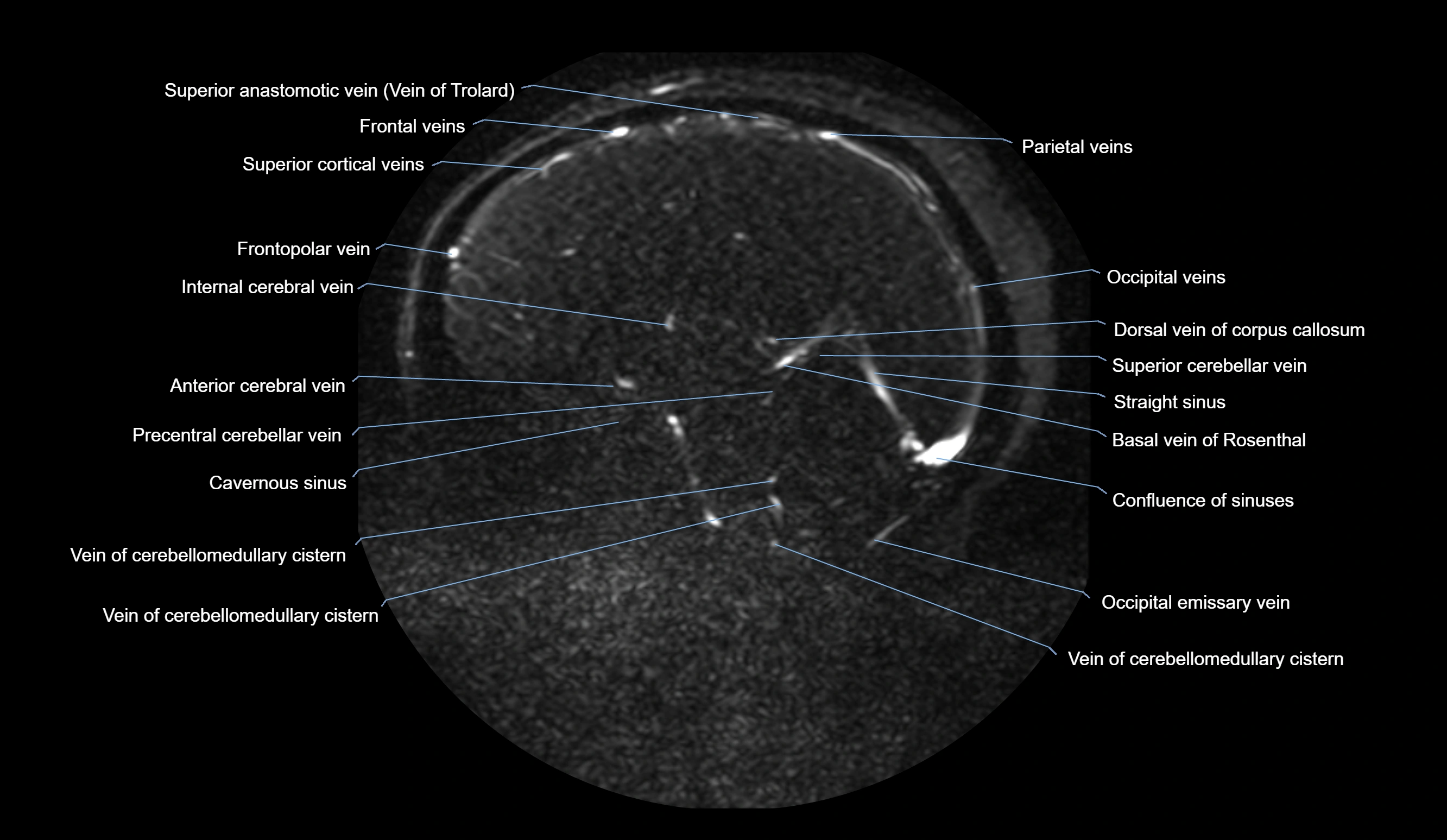 MRV brain sagittal anatomy 3T MRI labelledimages -00041.webp